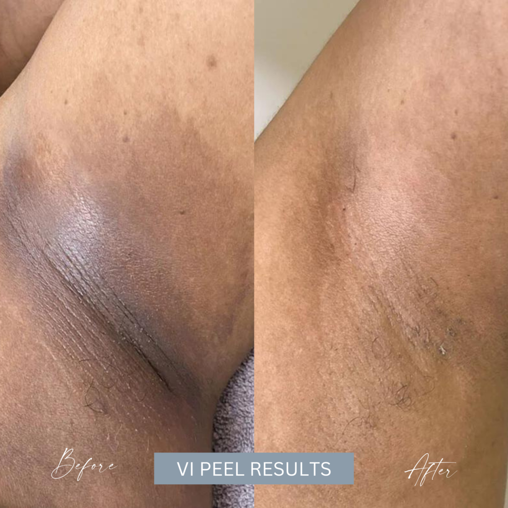 Dark Armpit Treatment Before and After