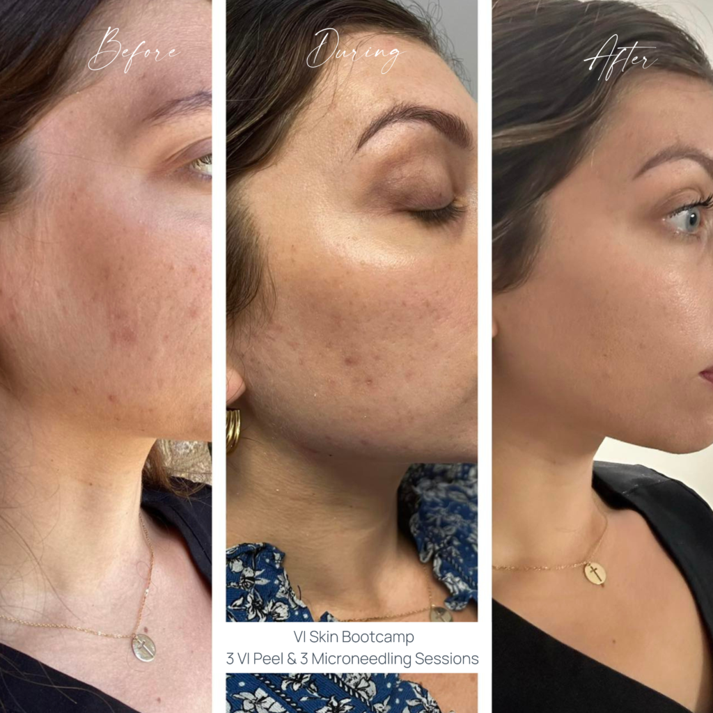 Skin Treatment Before and After