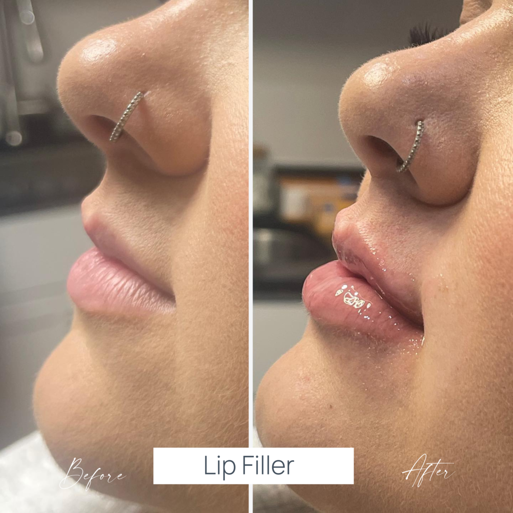 Lip fillers Before and after