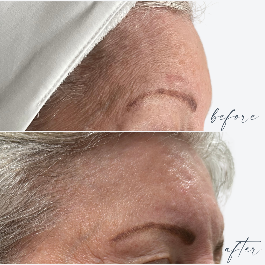 Forehead Treatment in Goldsboro NC