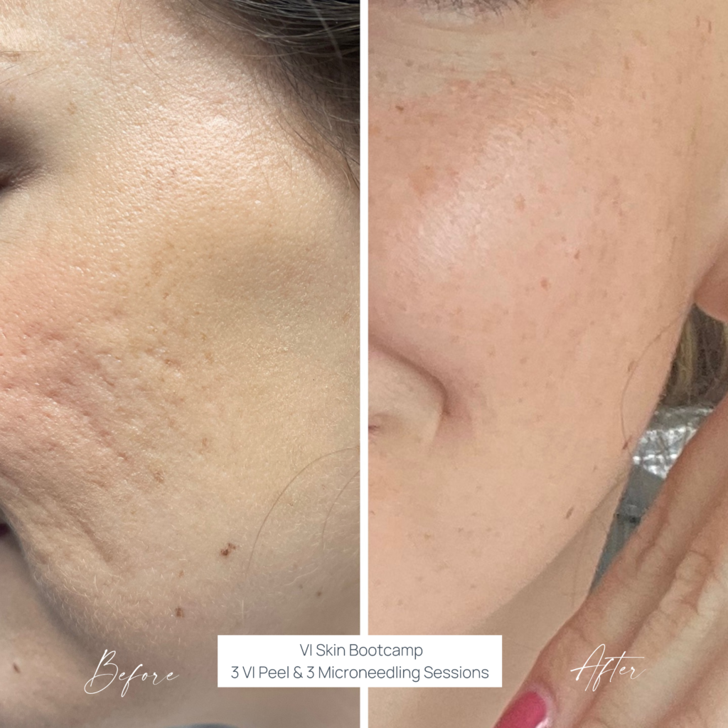 Skin Treatment Before and After