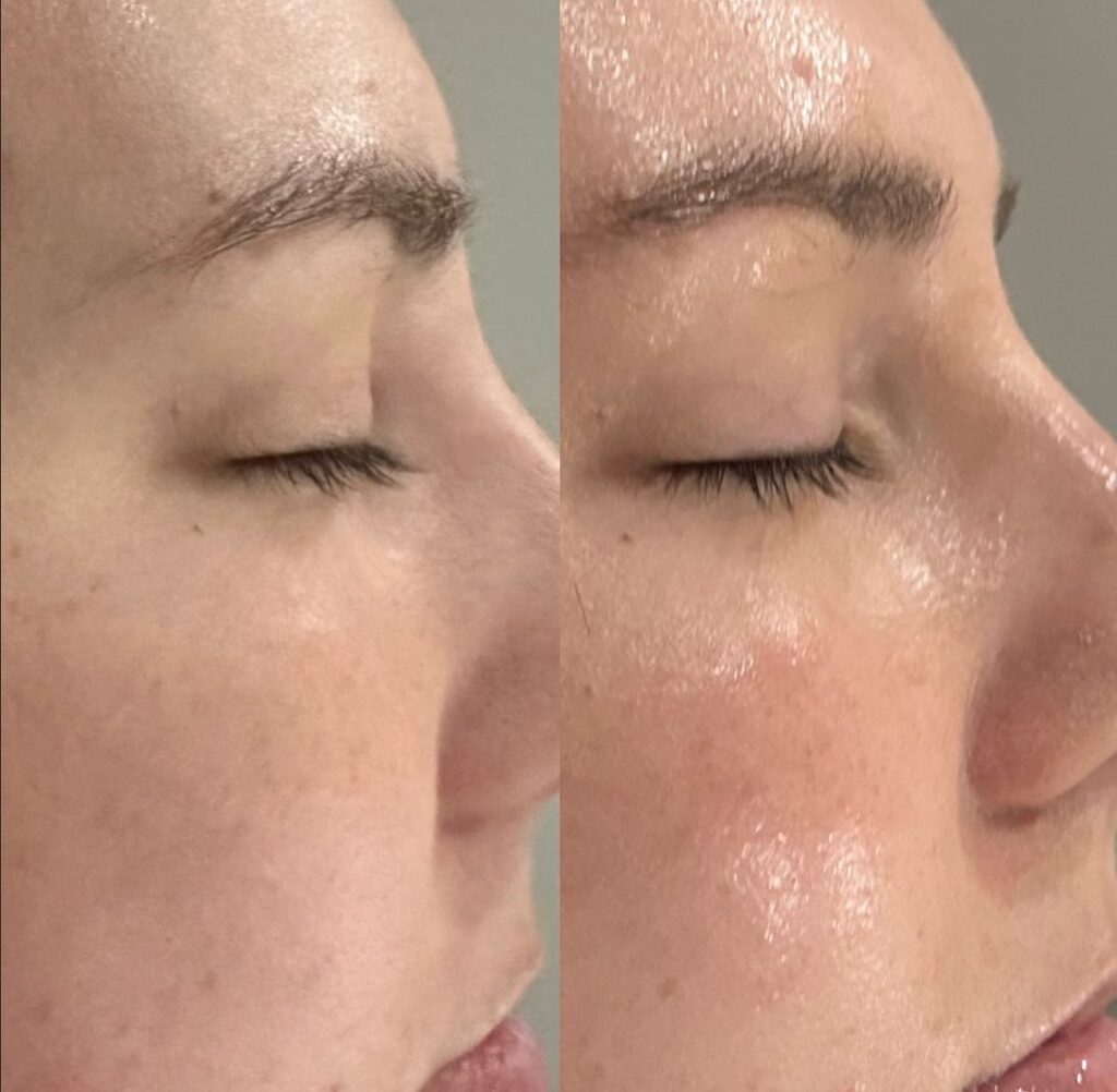 Facial and Chemical Peels