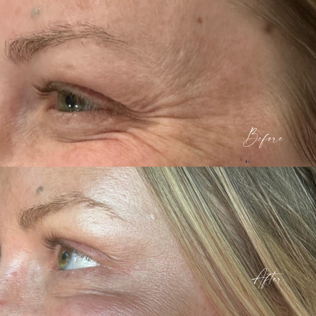 Wrinkles Before and After
