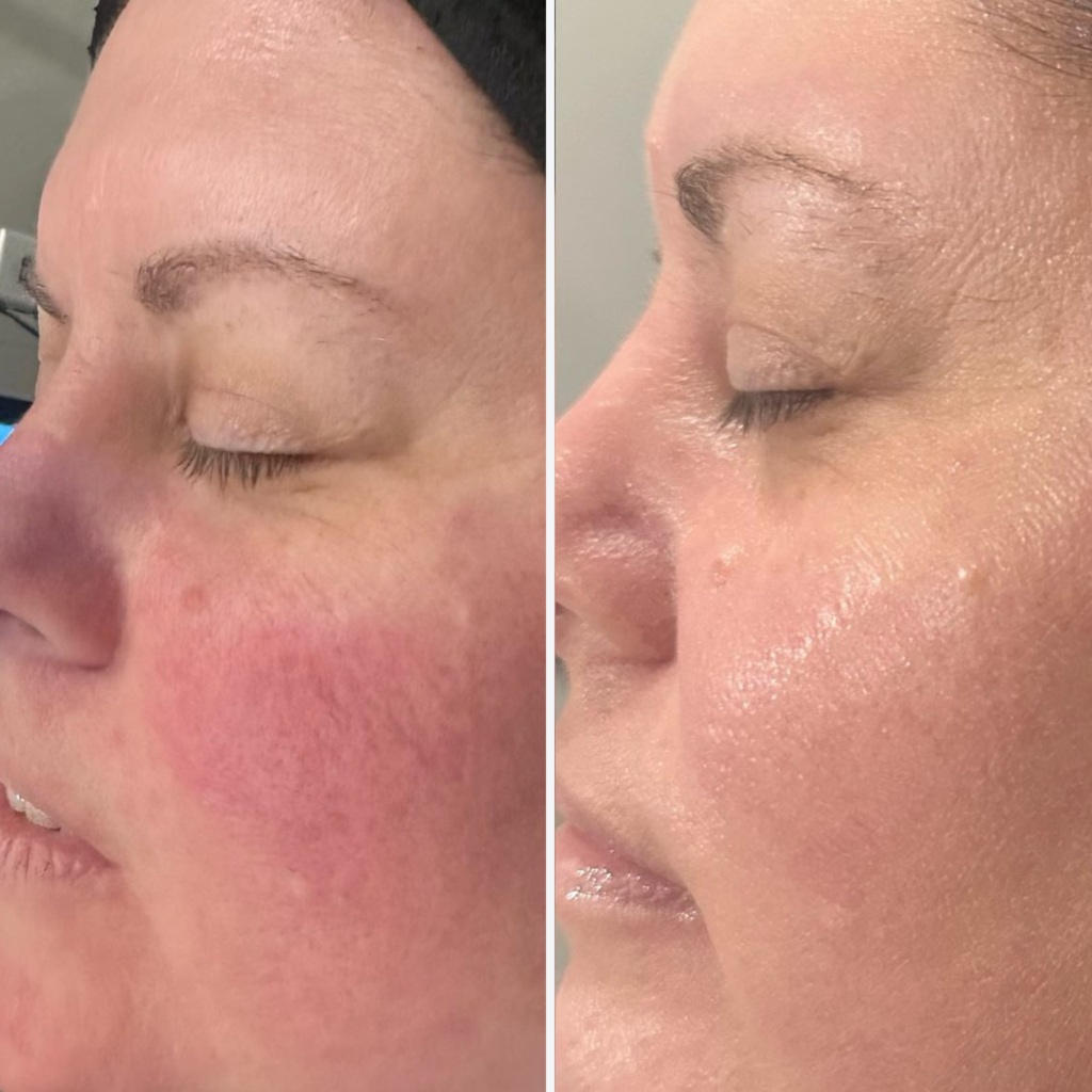 Facials and Chemical Peels