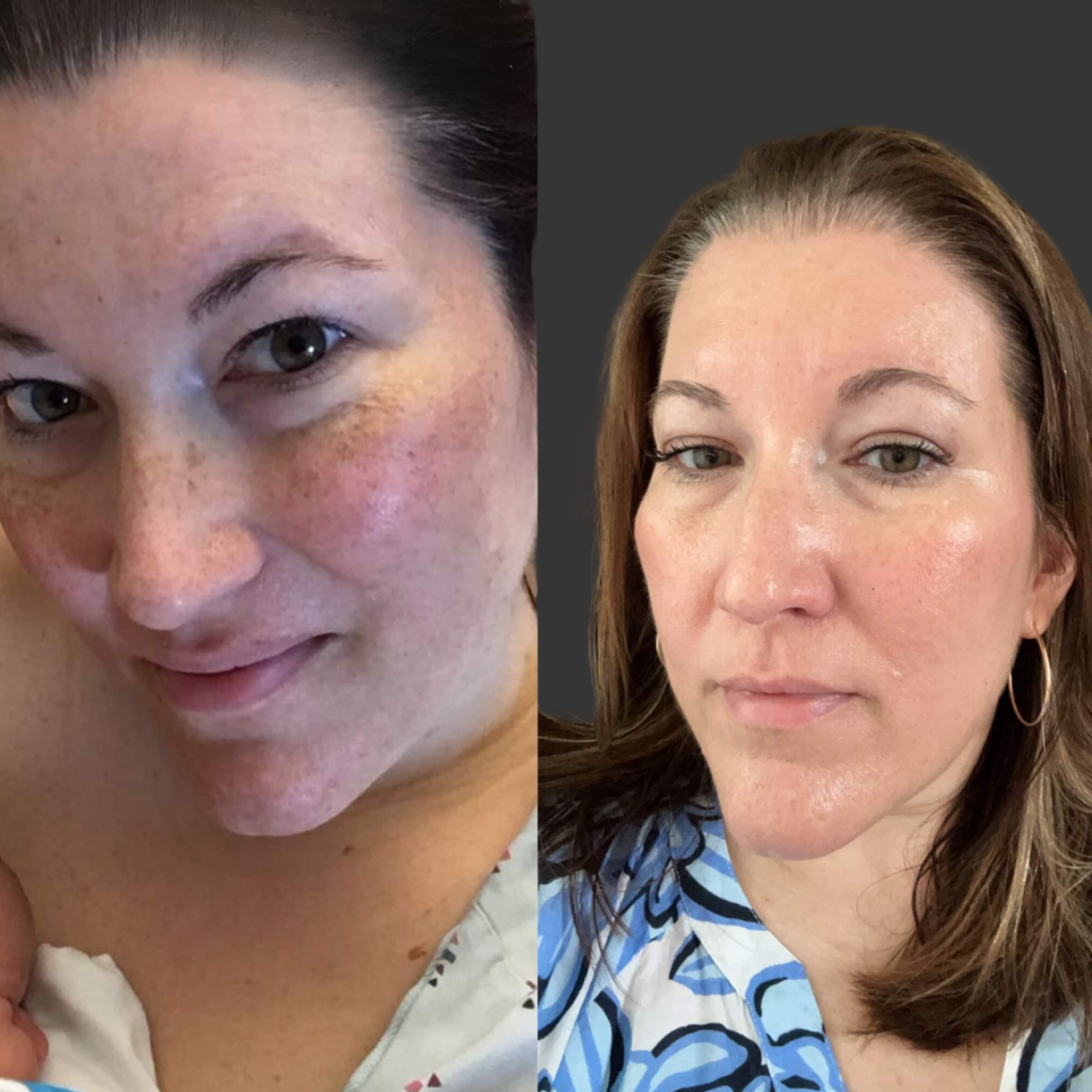 Facials and Chemical Peels