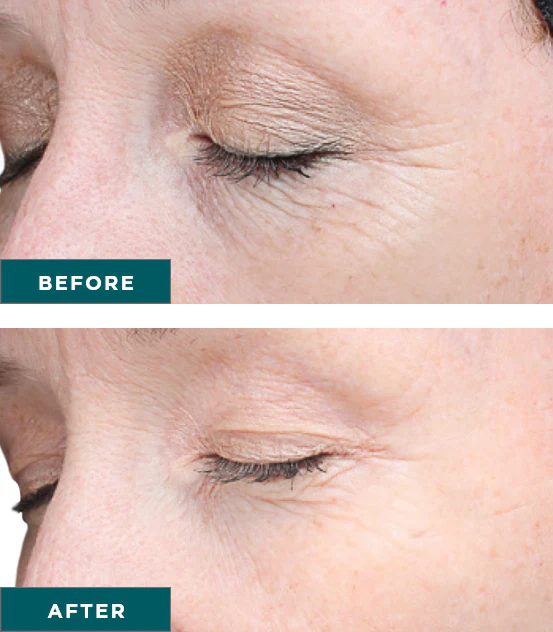 Facials and Chemical Peels