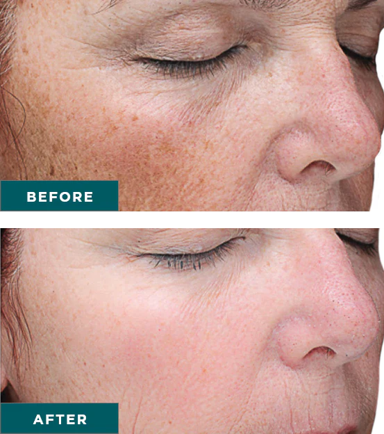 Facials and Chemical Peels
