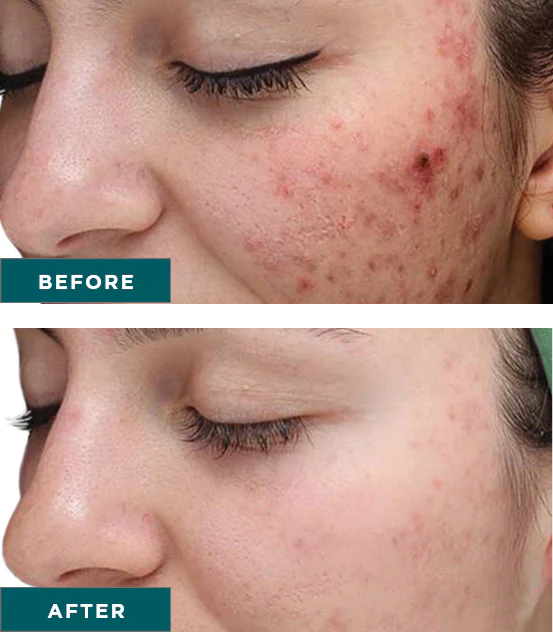 Facials and Chemical Peels