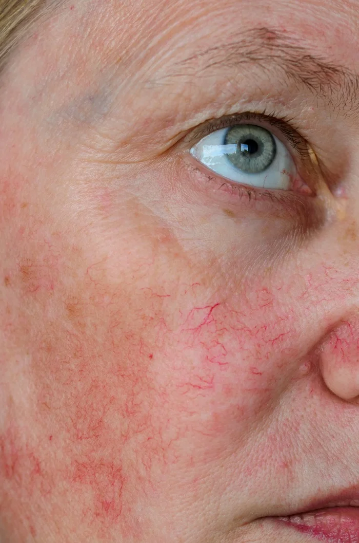 Laser Vascular Treatment for Spider Veins in Goldsboro NC