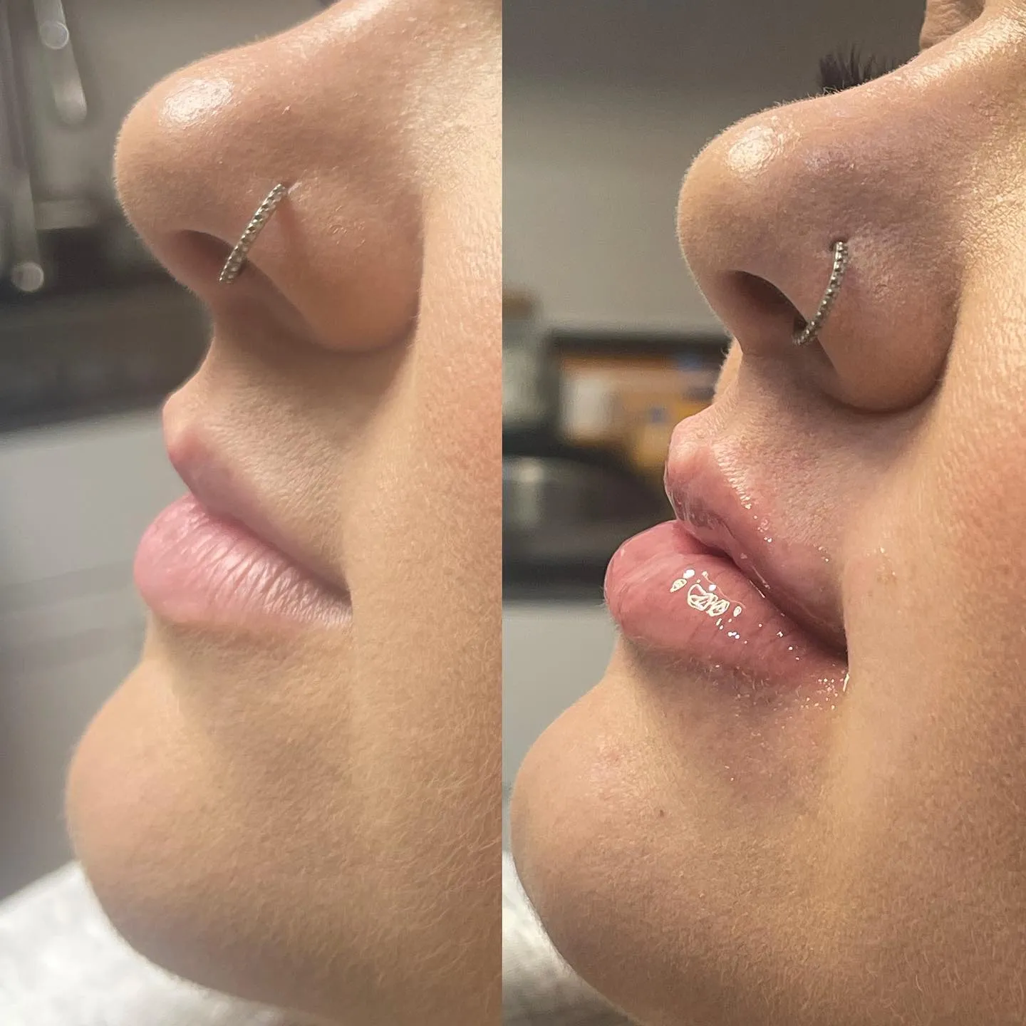 Lip Fillers In Goldsboro NC