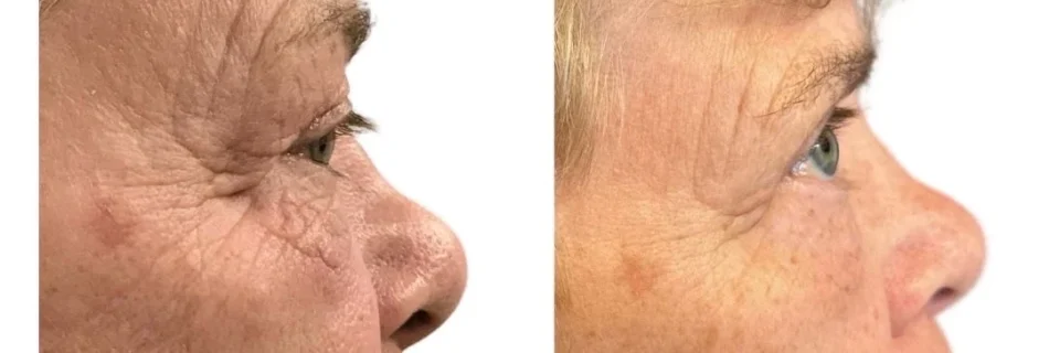 Eye Lines and Wrinkles Before and After
