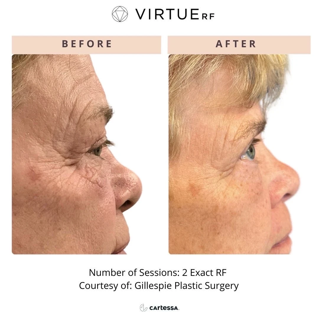 Eye Lines and Wrinkles Before and After