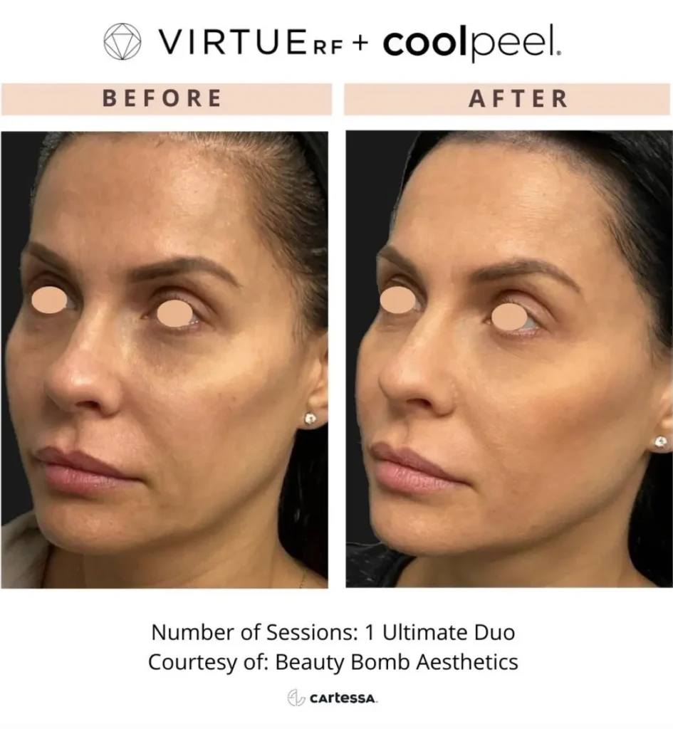 Virtuerf + Coolpeel Before and After