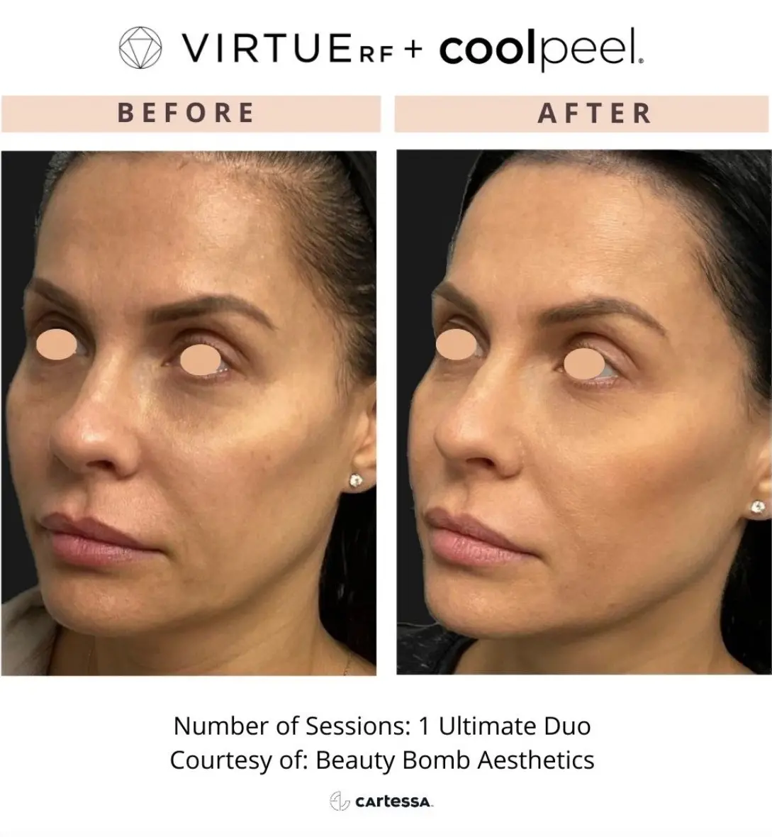 Virtuerf + Coolpeel Before and After
