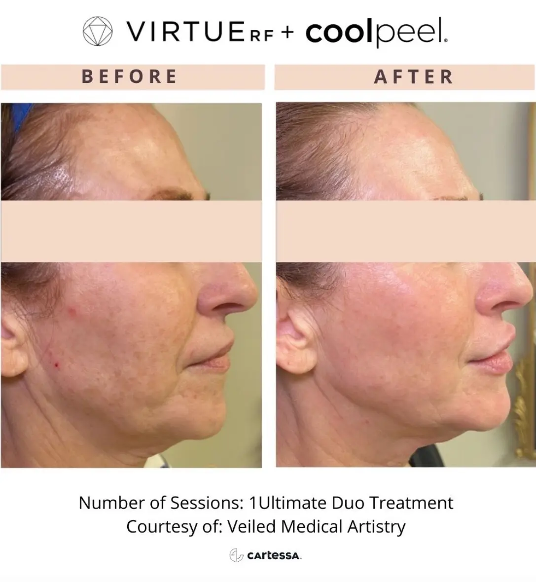 Virtuerf + Coolpeel Before and After