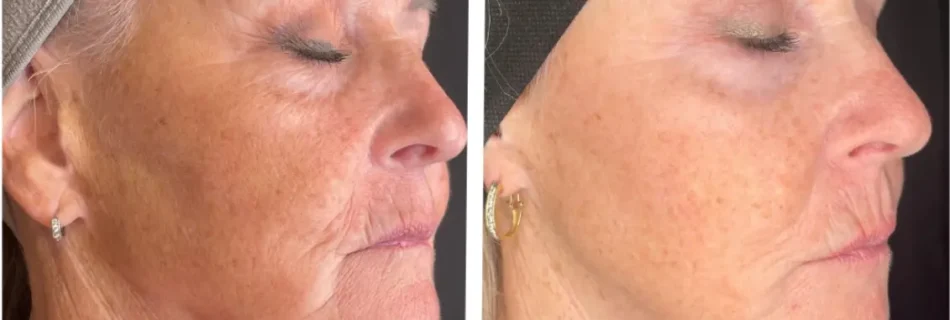 Virtuerf + Coolpeel Before and After
