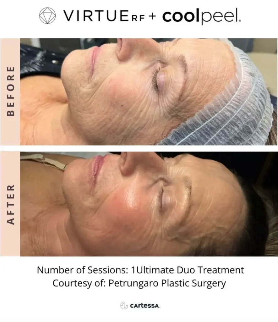 Face Lines Treatment Before and After