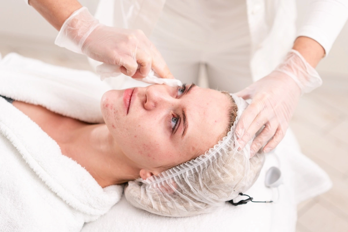 Anti-Acne Facials in Goldsboro