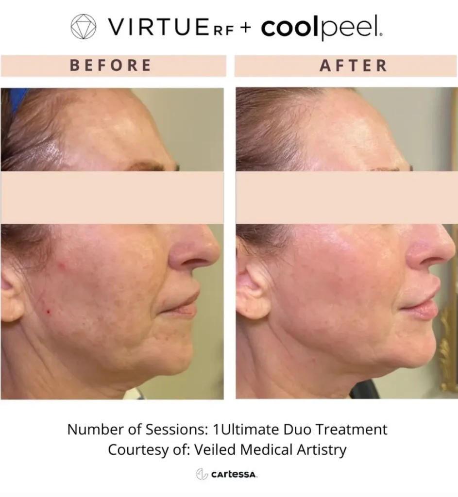 Virtuerf Coolpeel before & after