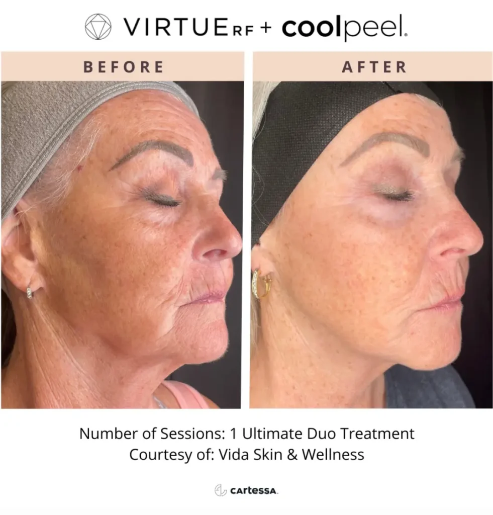 Virtuerf Coolpeel before & after