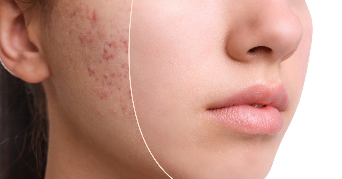 What is Tetra CO2 Cool Peel® and How Does It Work?